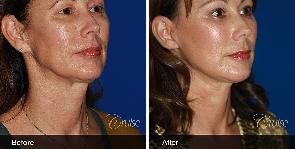 Neck Lift Before & After
