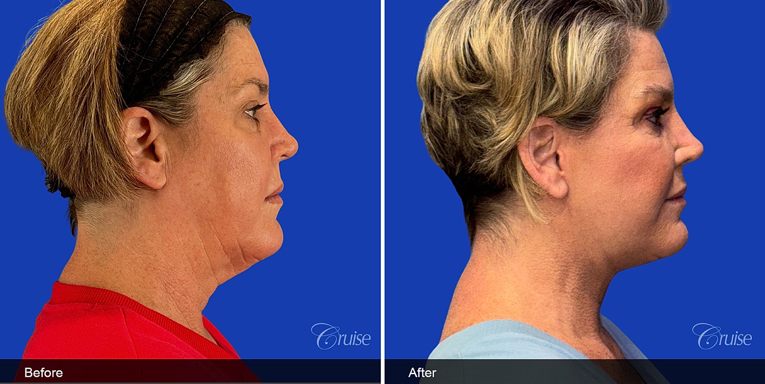 Neck Lift Before & After