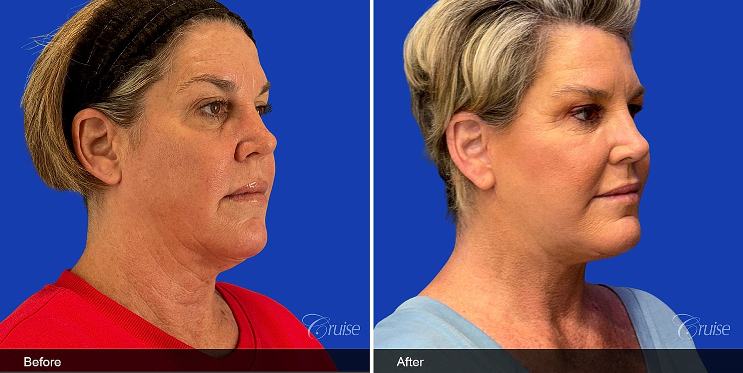 Neck Lift Before & After