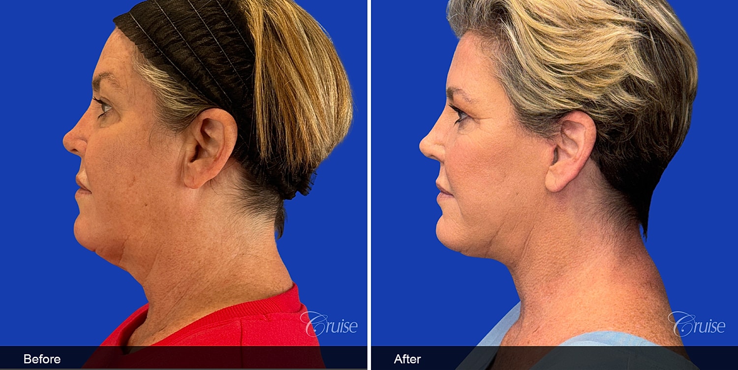Neck Lift Before & After