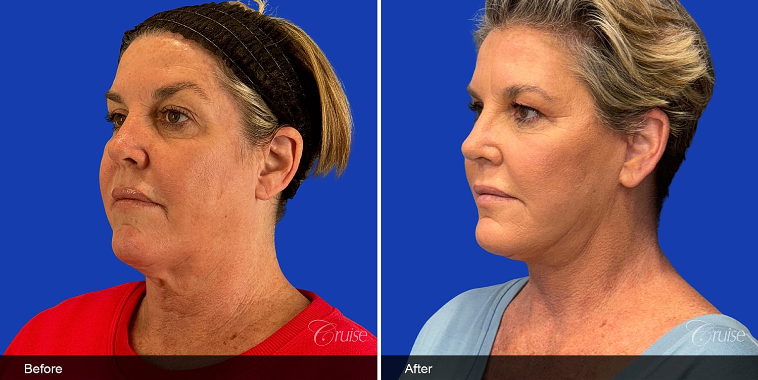 Neck Lift Before & After