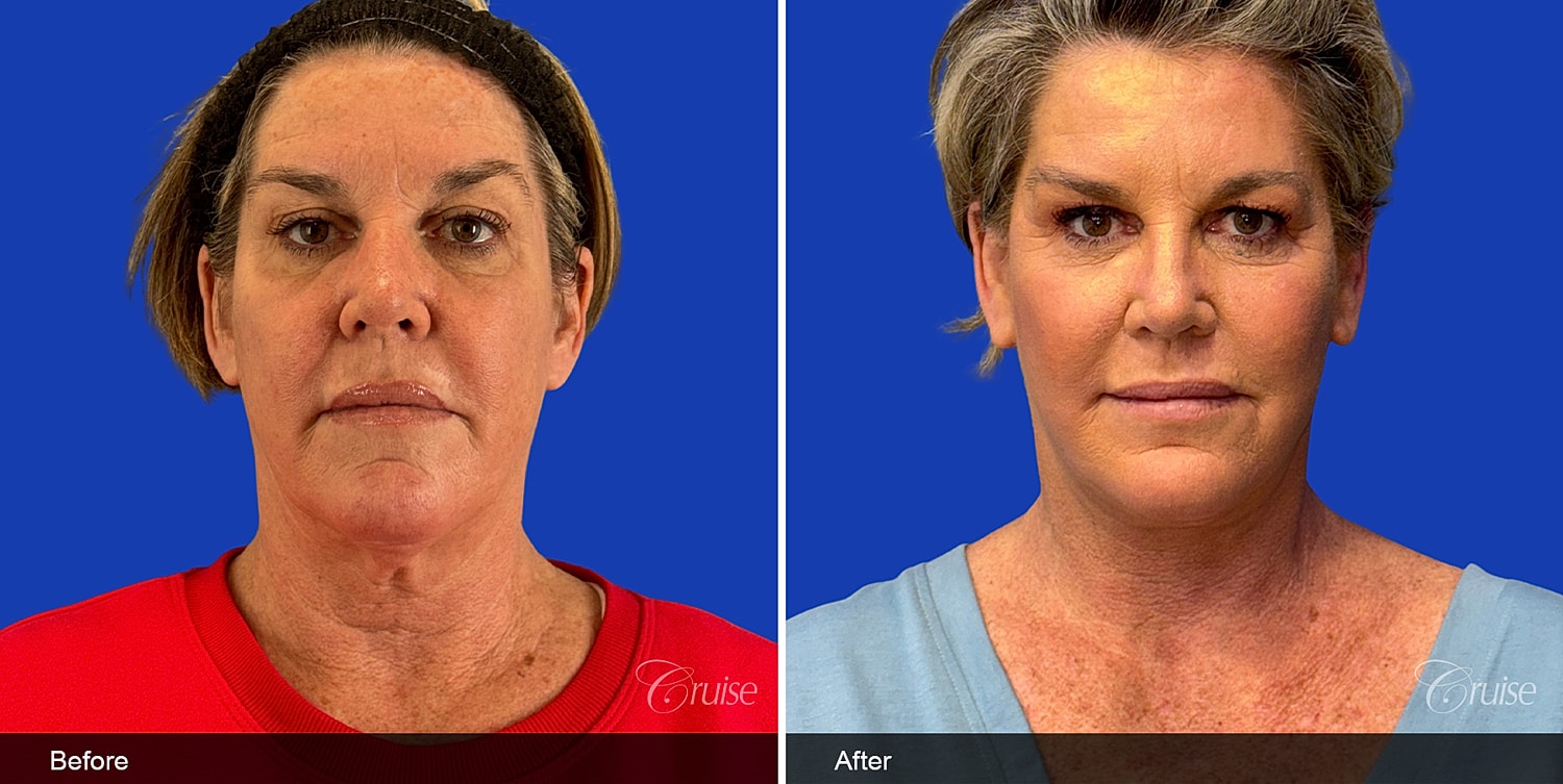 Neck Lift Before & After
