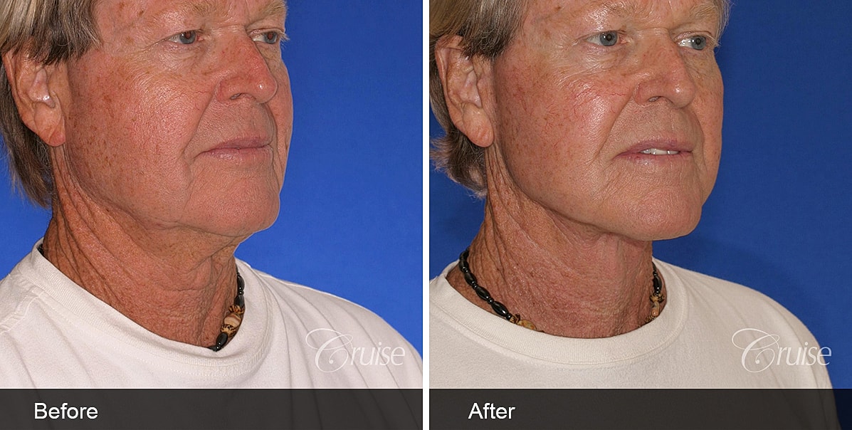 Neck Lift Before & After
