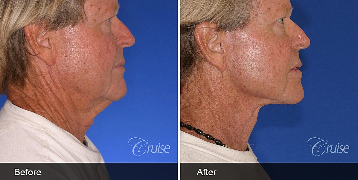 Neck Lift Before & After