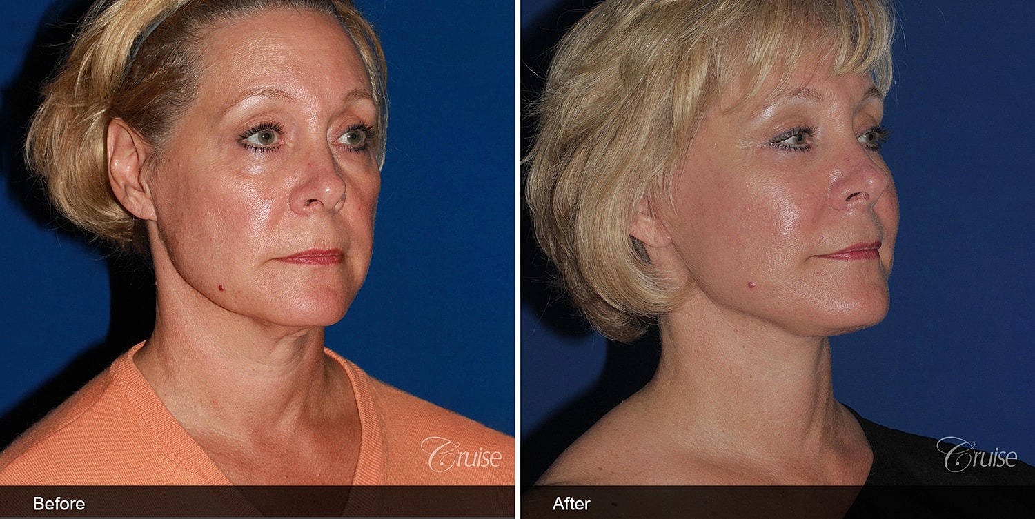 Neck Lift Before & After