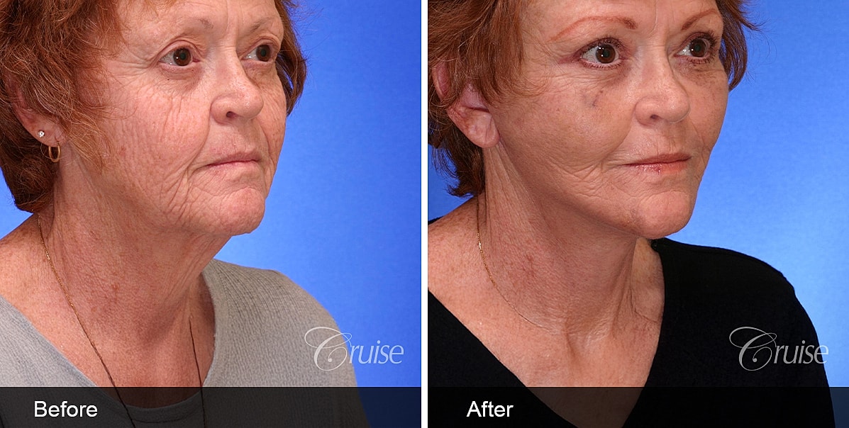 Neck Lift Before & After