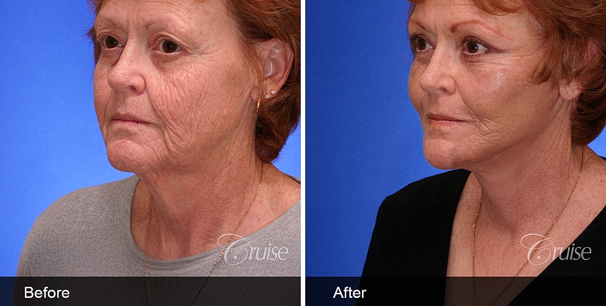Neck Lift Before & After
