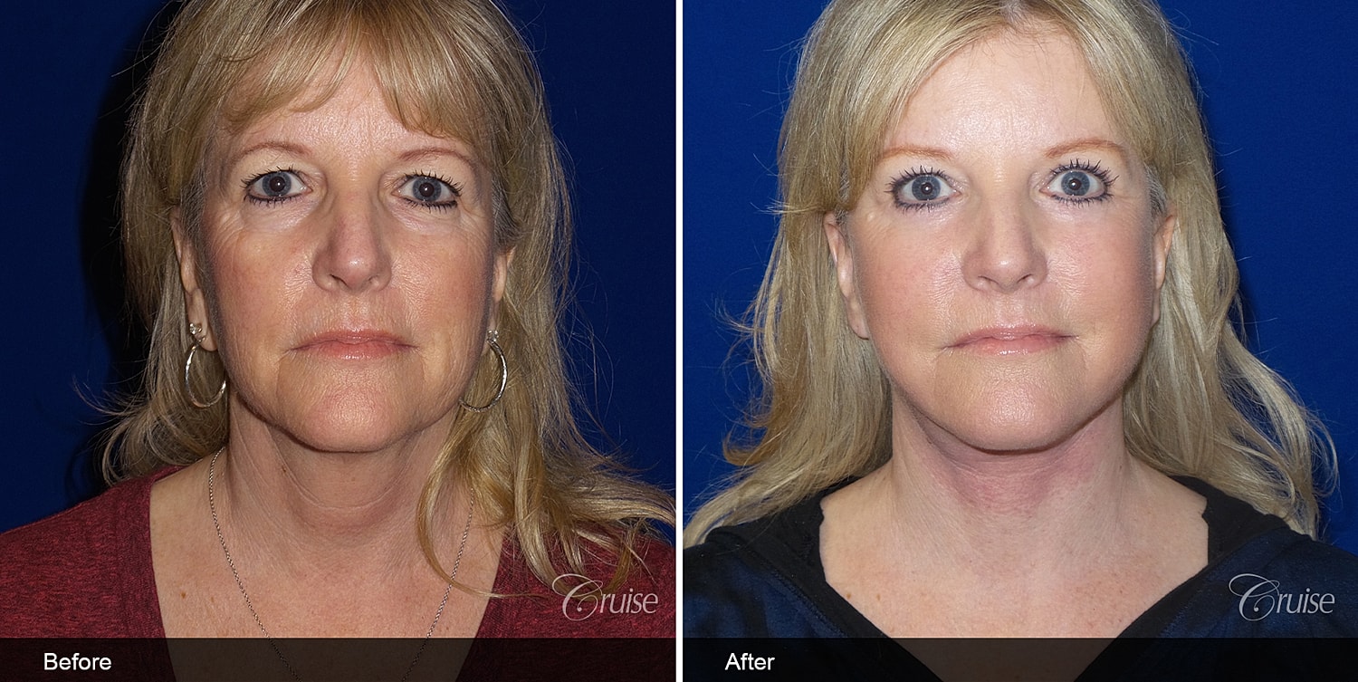 Neck Lift Before & After