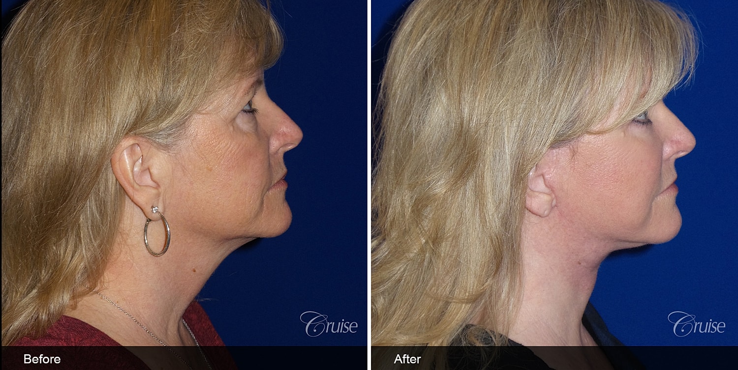 Neck Lift Before & After