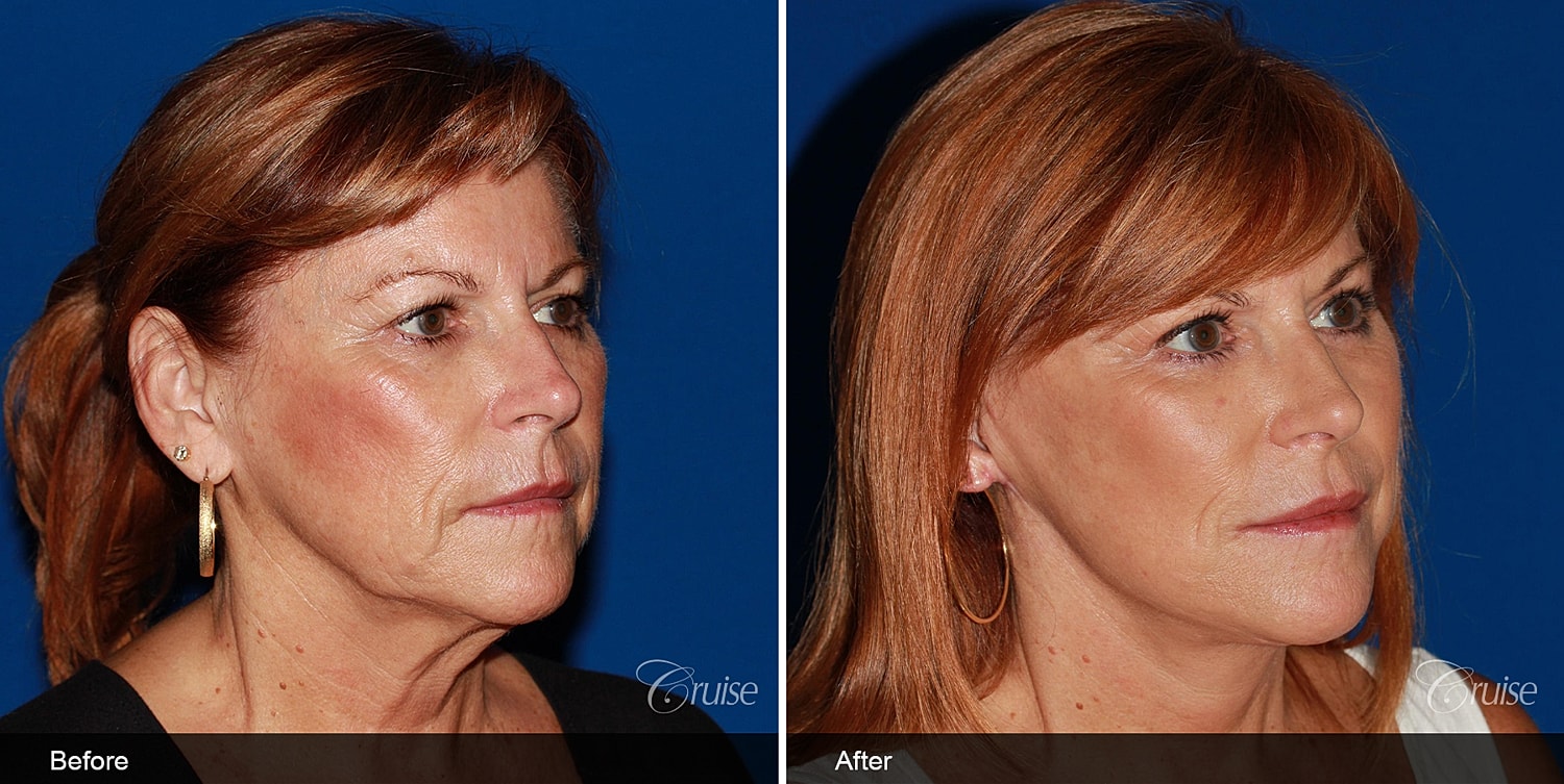 Neck Lift Before & After