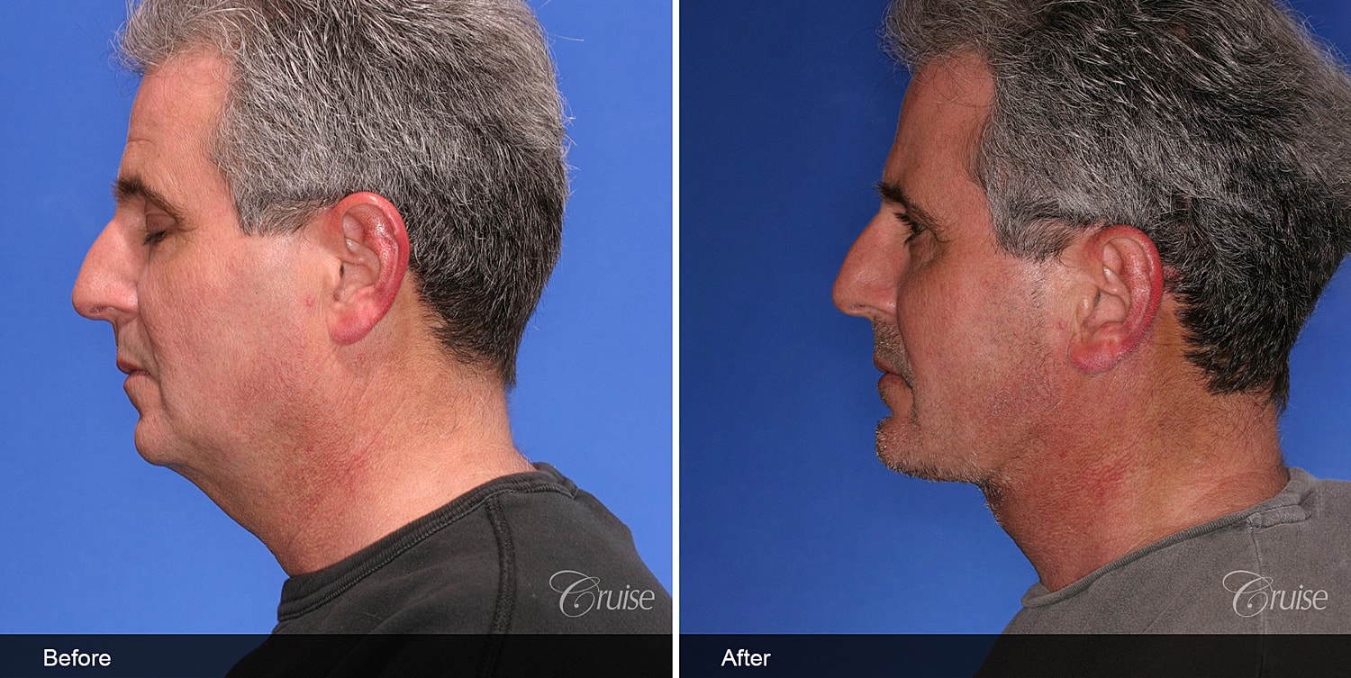 Neck Lift Before & After