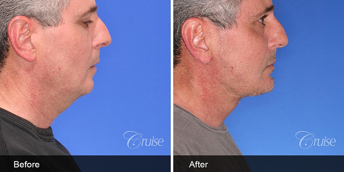 Neck Lift Before & After