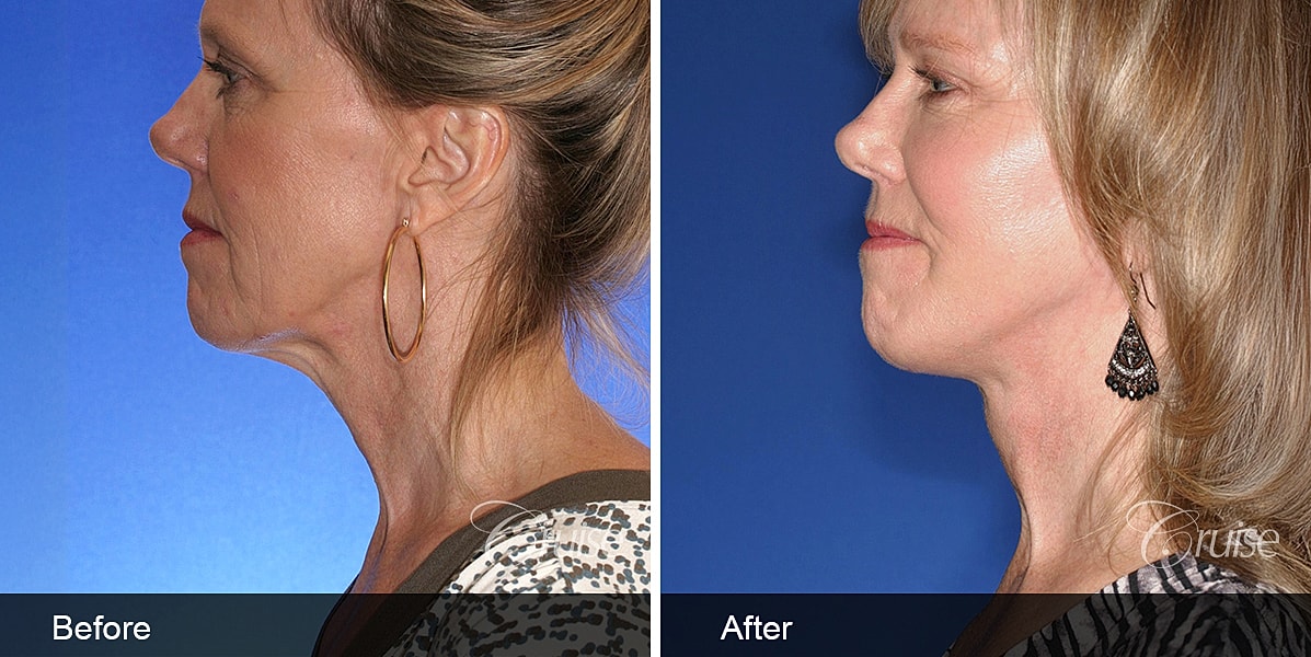 Neck Lift Before & After