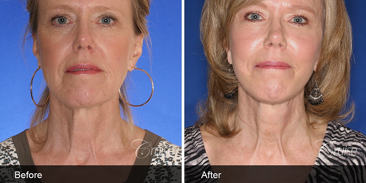 Neck Lift Before & After