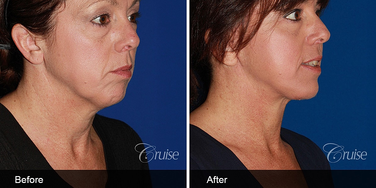 Neck Lift Before & After