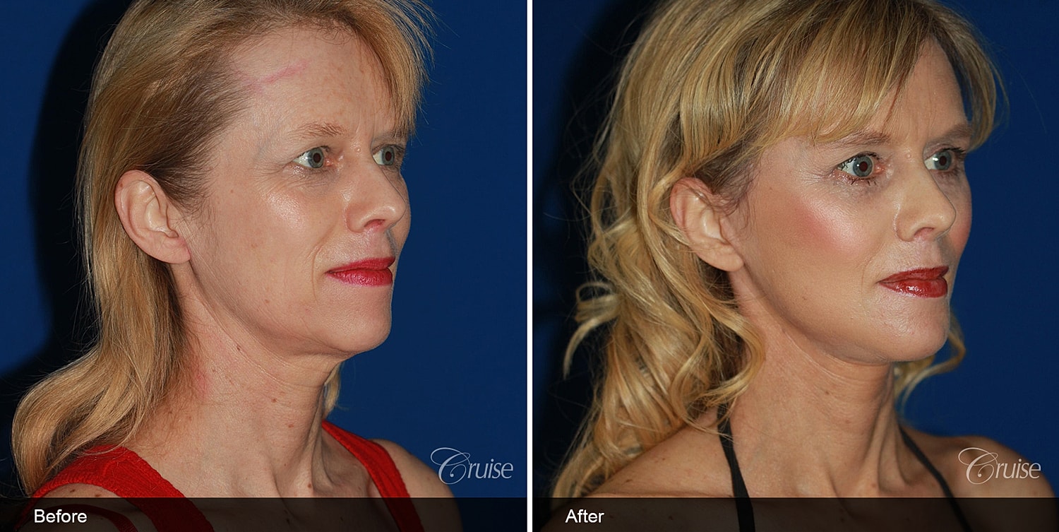 Neck Lift Before & After