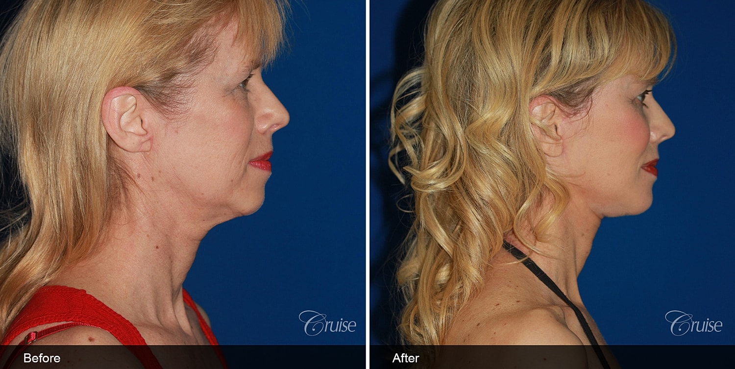 Neck Lift Before & After