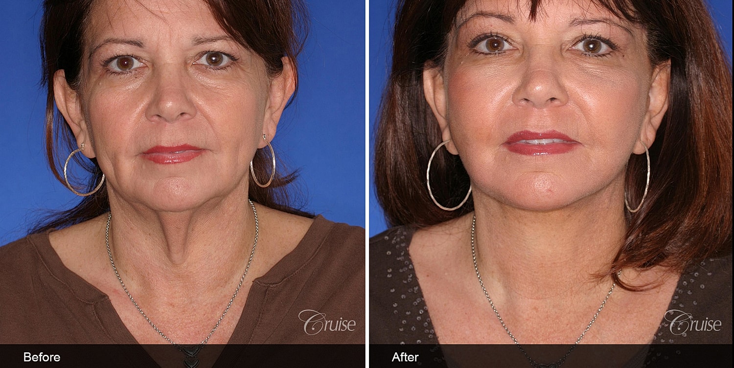 Neck Lift Before & After