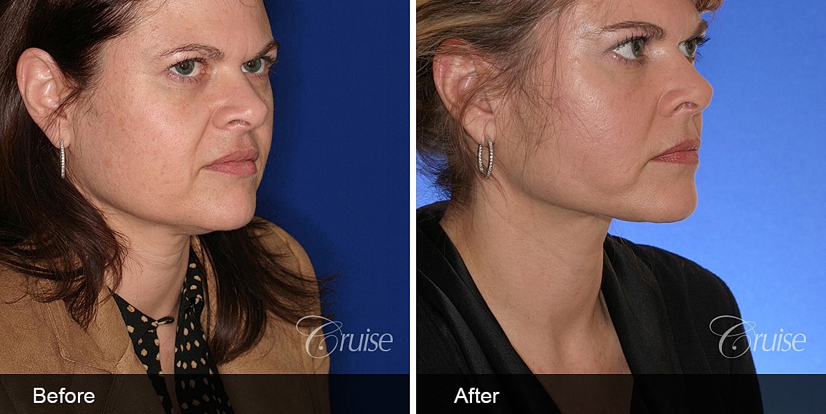 Neck Lift Before & After