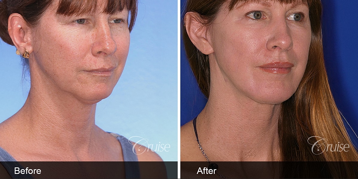 Neck Lift Before & After