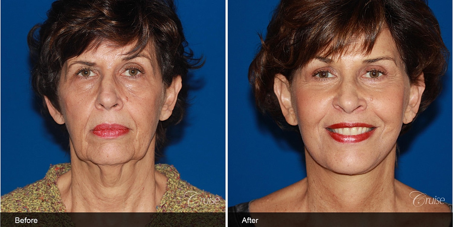 Neck Lift Before & After