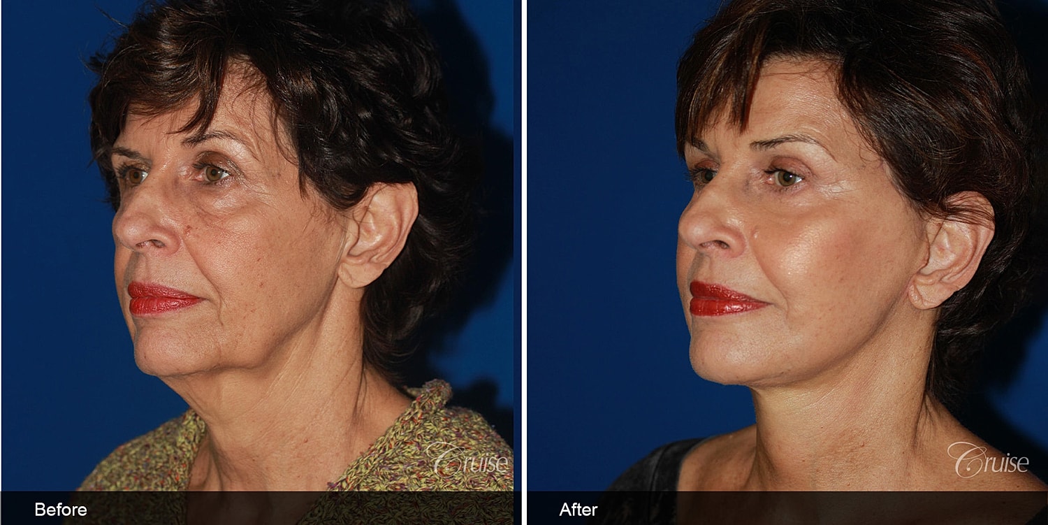 Neck Lift Before & After