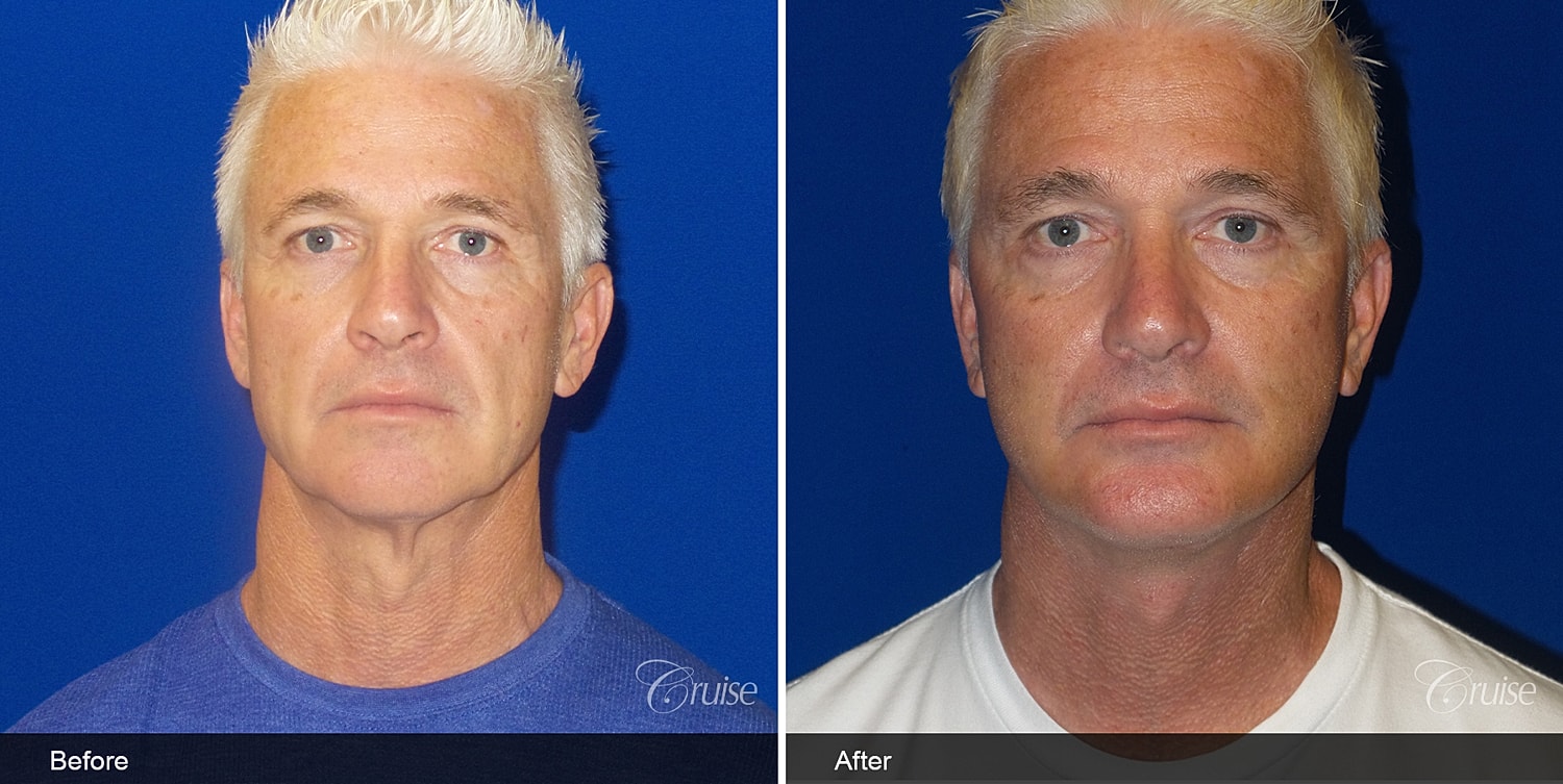Neck Lift Before & After