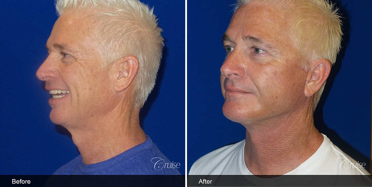 Neck Lift Before & After