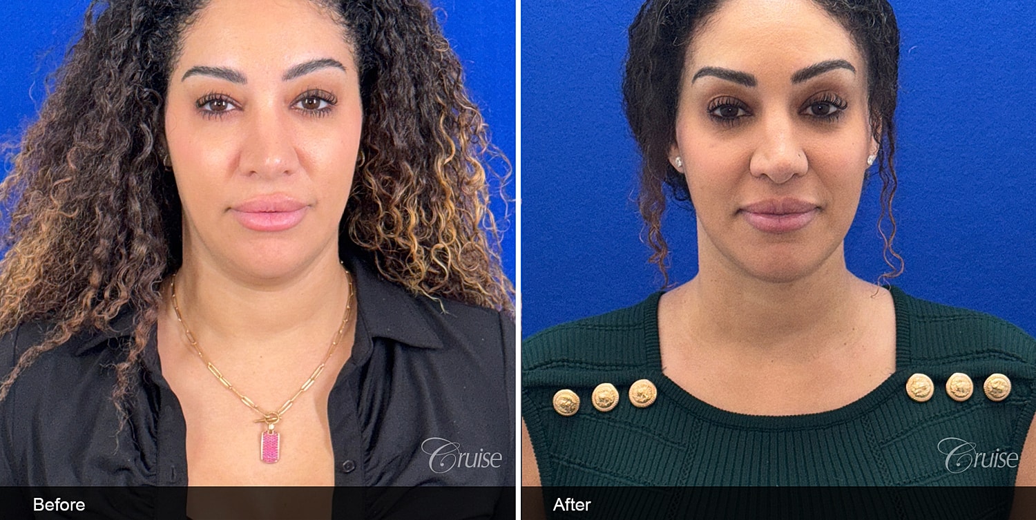 Neck Lift Before & After