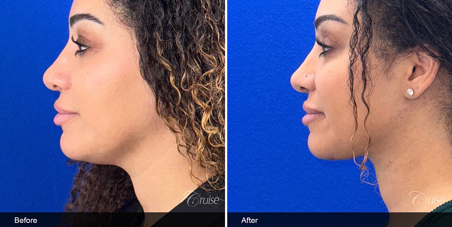 Neck Lift Before & After