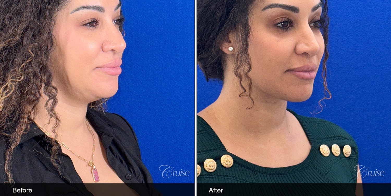 Neck Lift Before & After