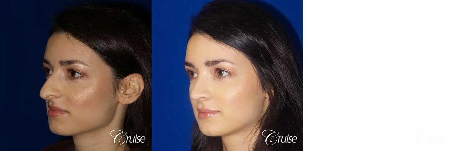 Rhinoplasty Before & After