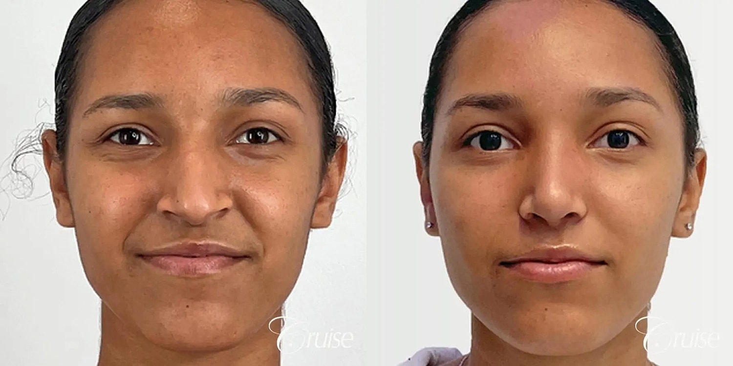 Rhinoplasty Before & After