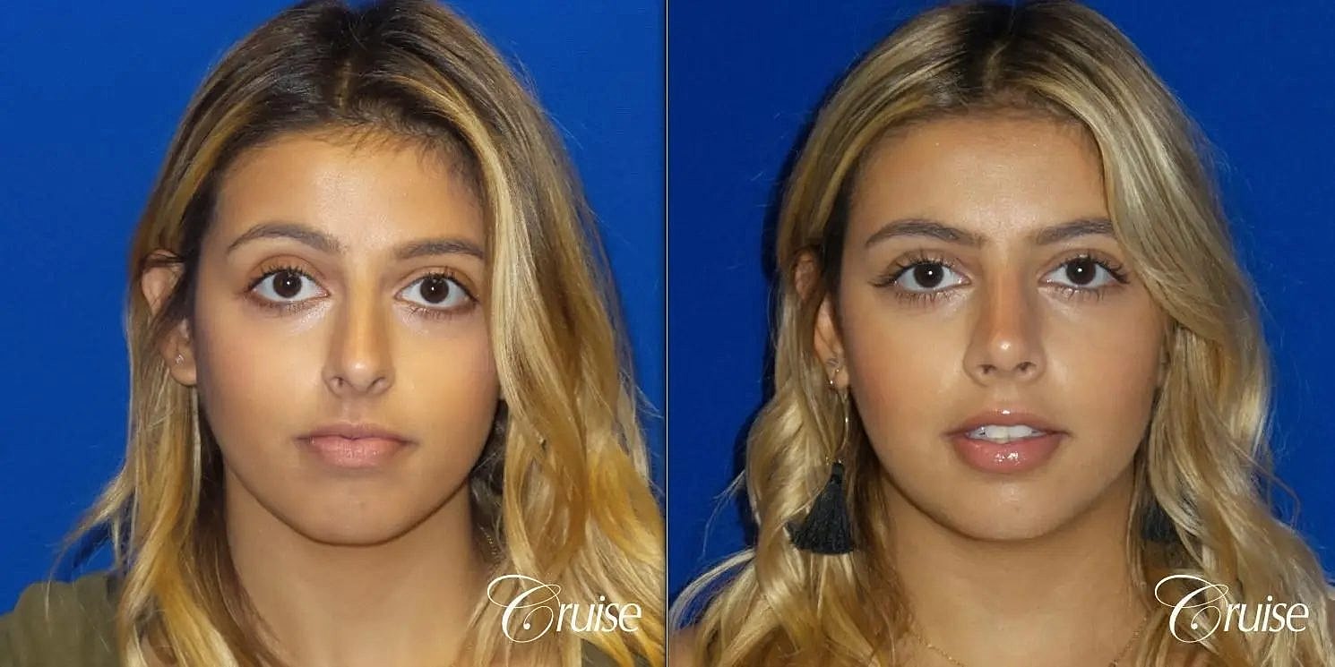 Rhinoplasty Before & After