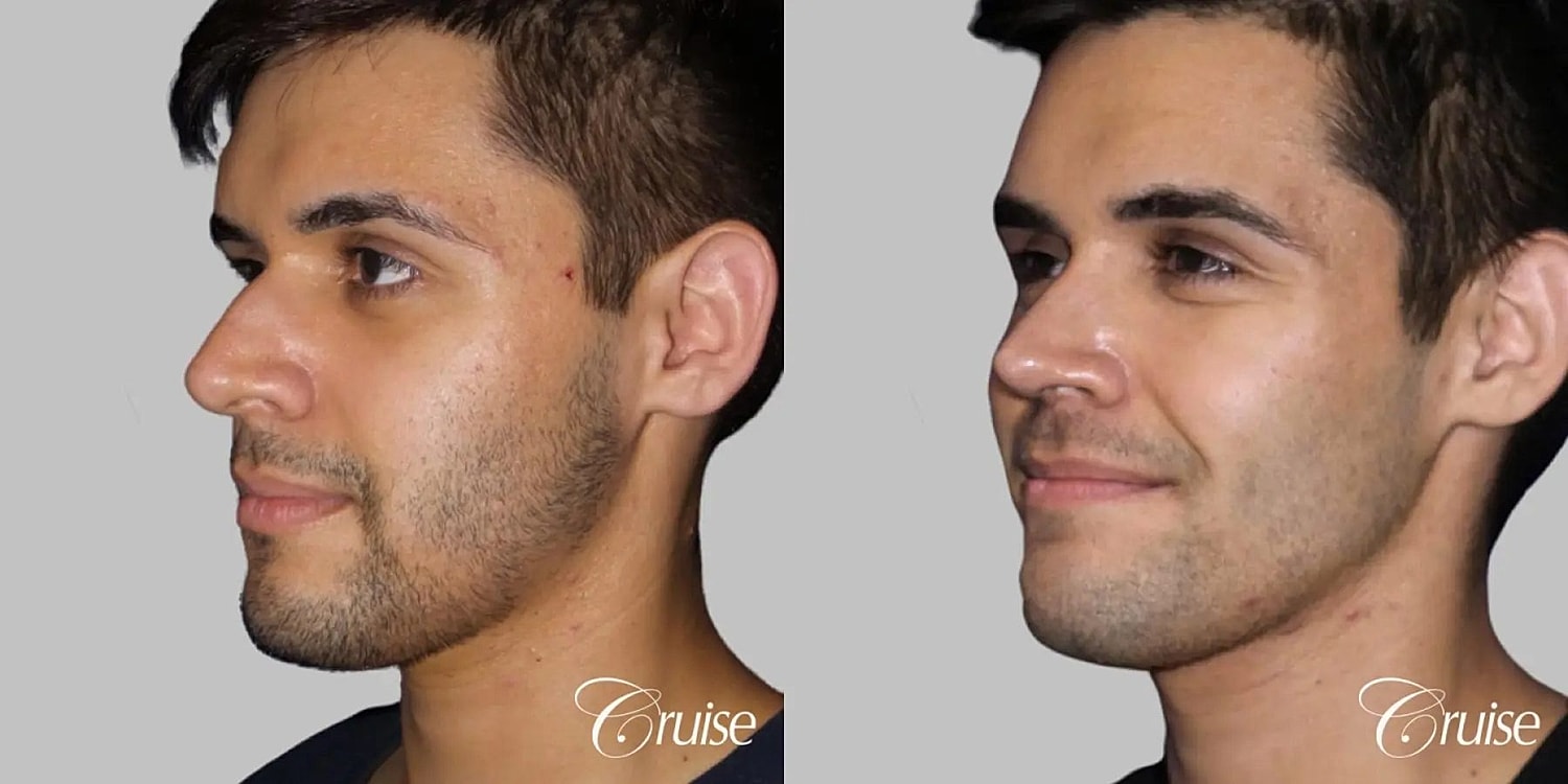 Rhinoplasty Before & After