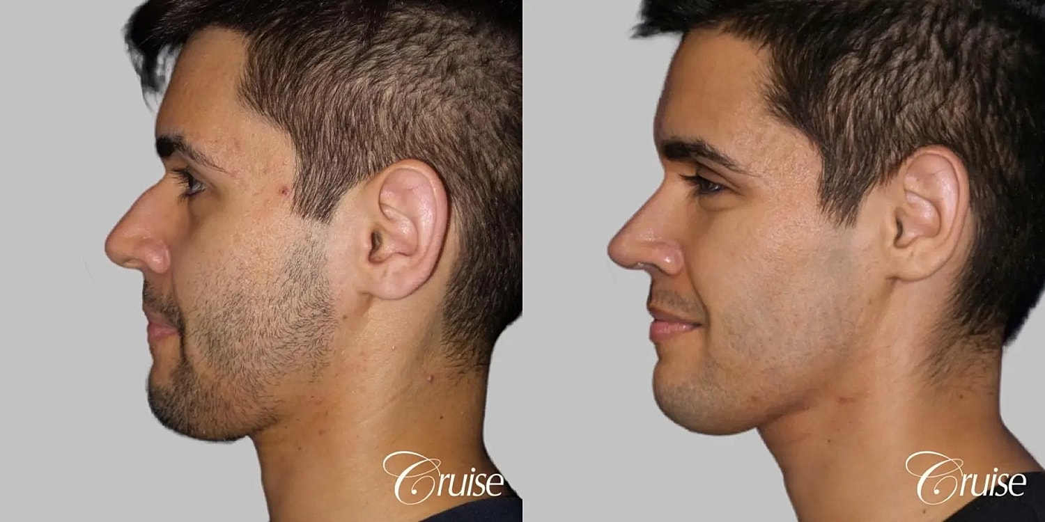 Rhinoplasty Before & After