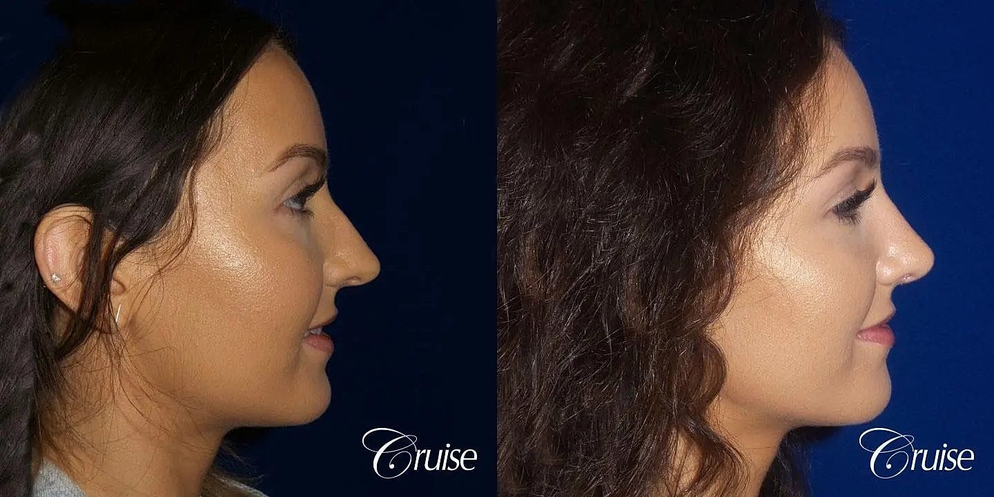 Rhinoplasty Before & After