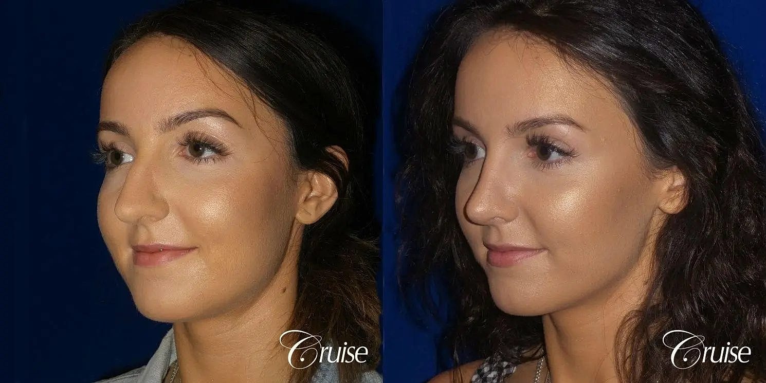 Rhinoplasty Before & After