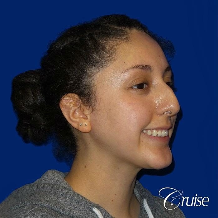 Rhinoplasty Before & After