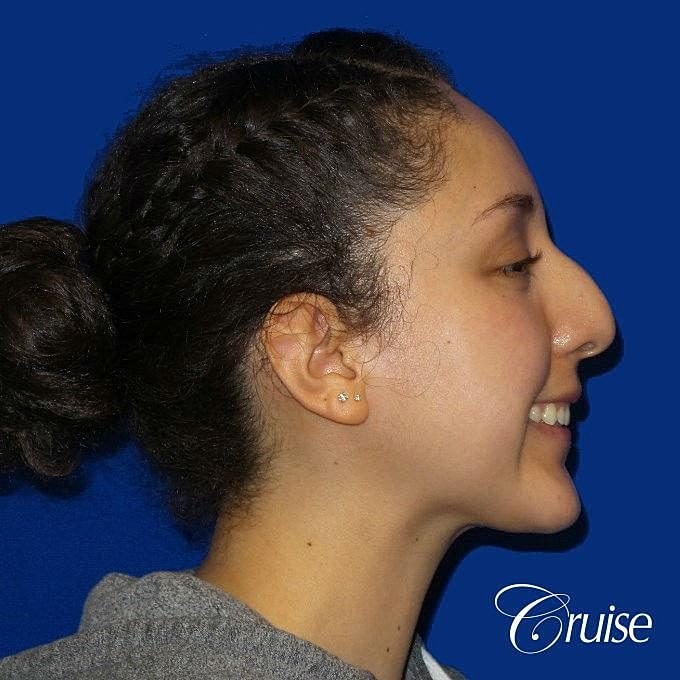 Rhinoplasty Before & After