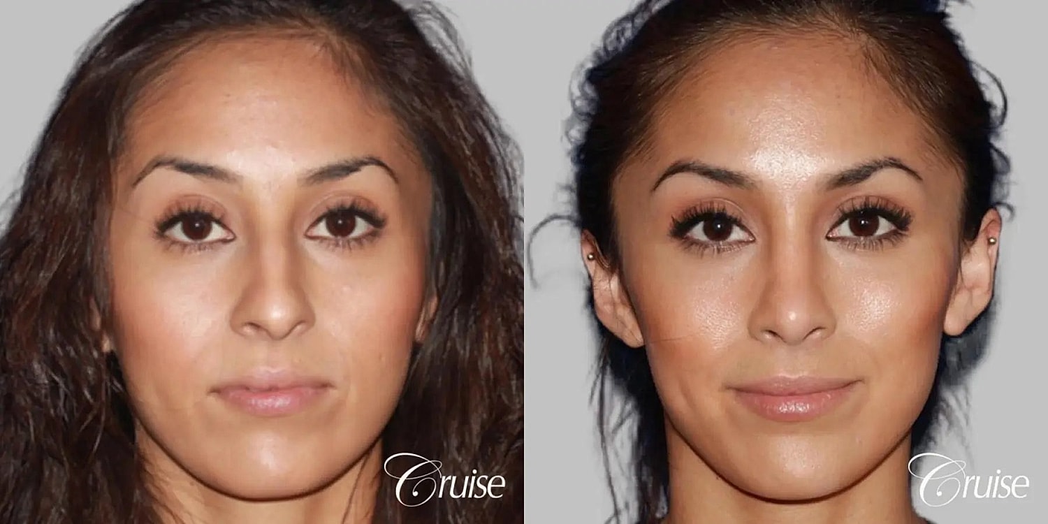 Rhinoplasty Before & After