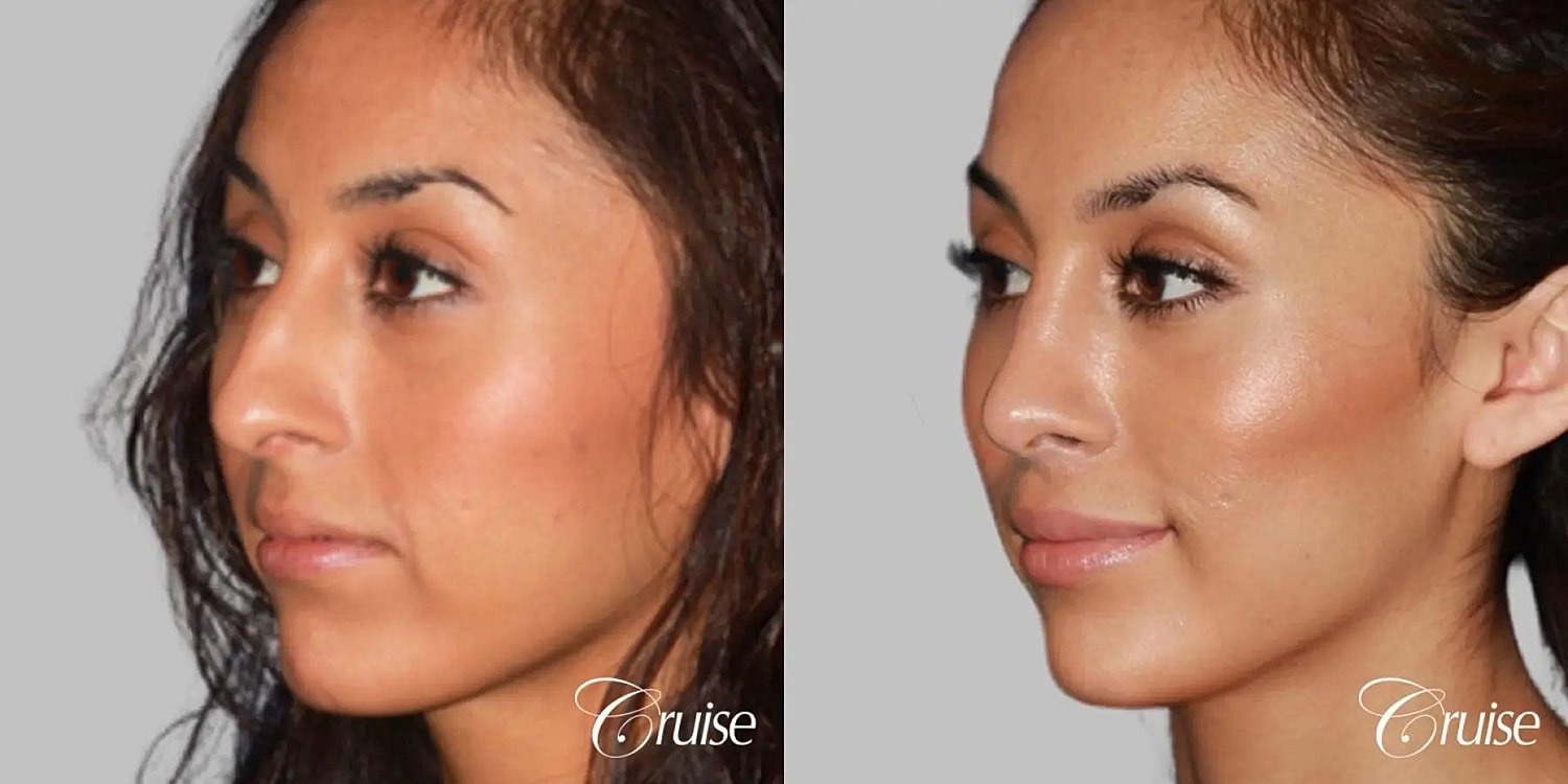 Rhinoplasty Before & After