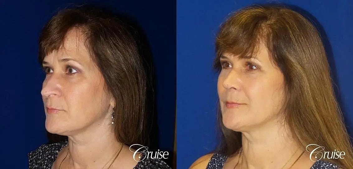 Rhinoplasty Before & After