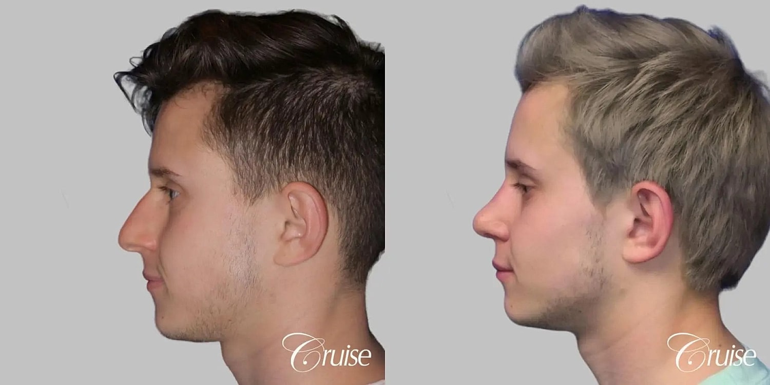 Rhinoplasty Before & After
