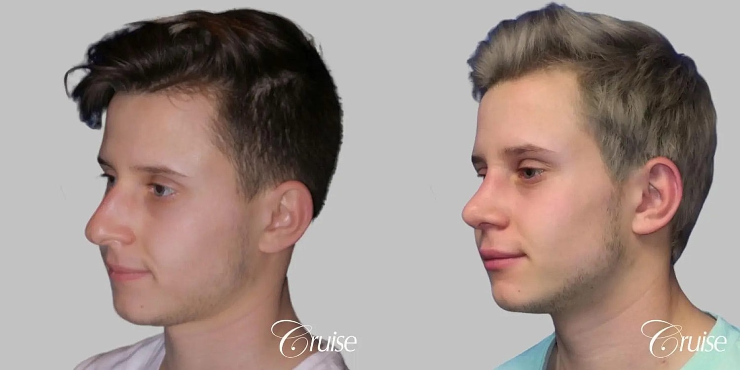 Rhinoplasty Before & After