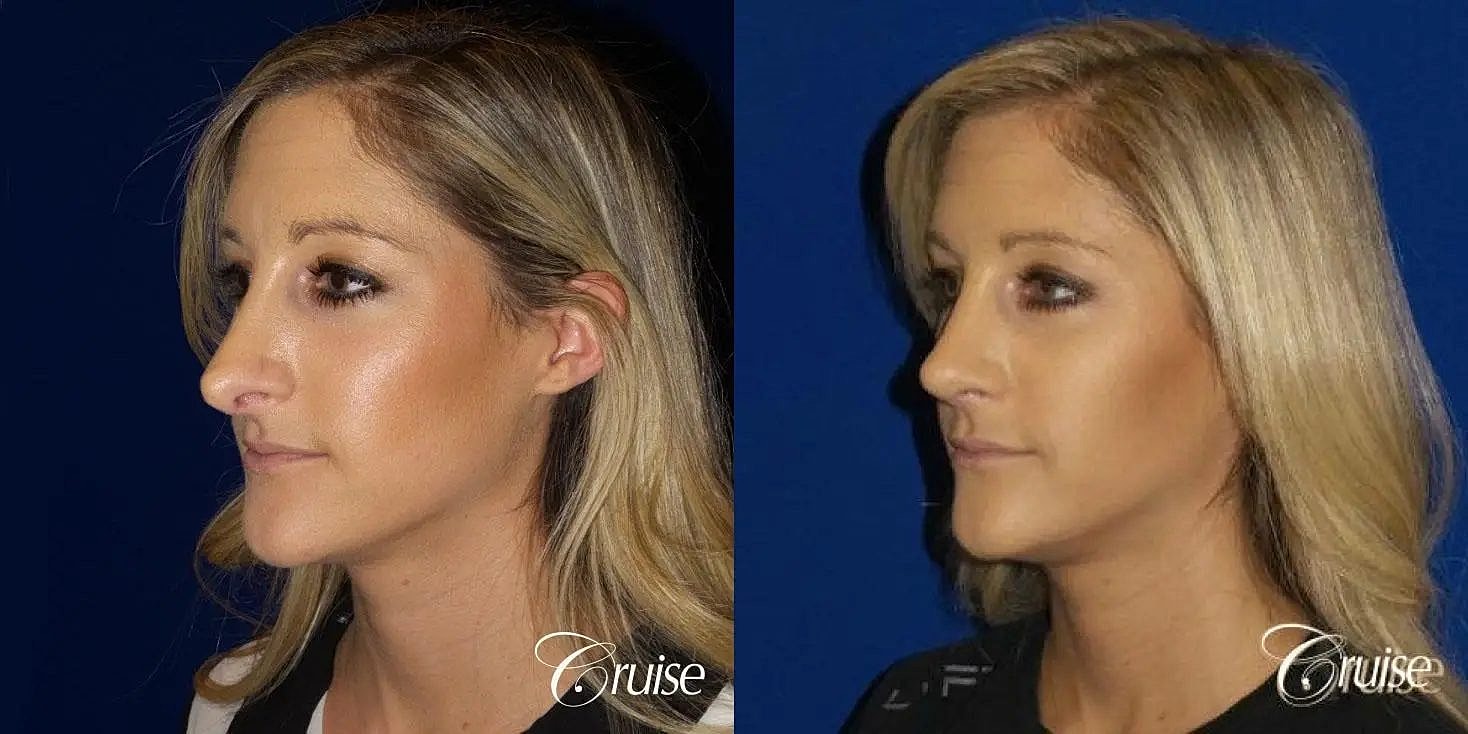 Rhinoplasty Before & After