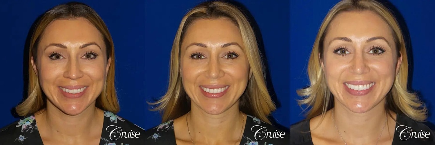 Rhinoplasty Before & After