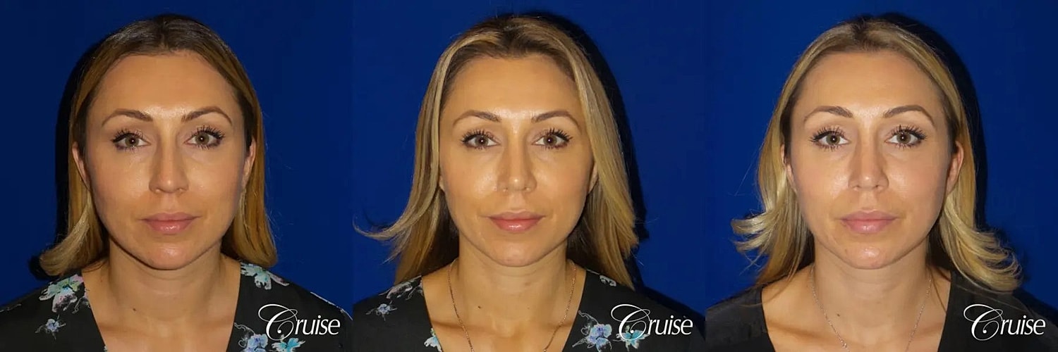 Rhinoplasty Before & After