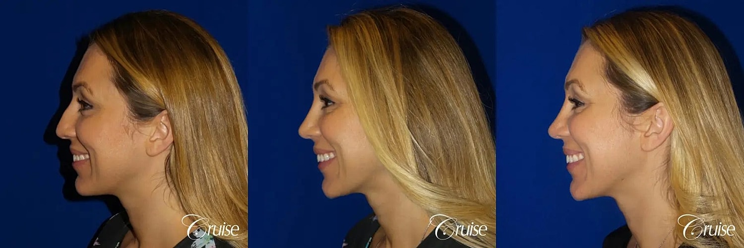 Rhinoplasty Before & After