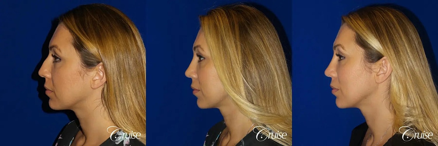 Rhinoplasty Before & After